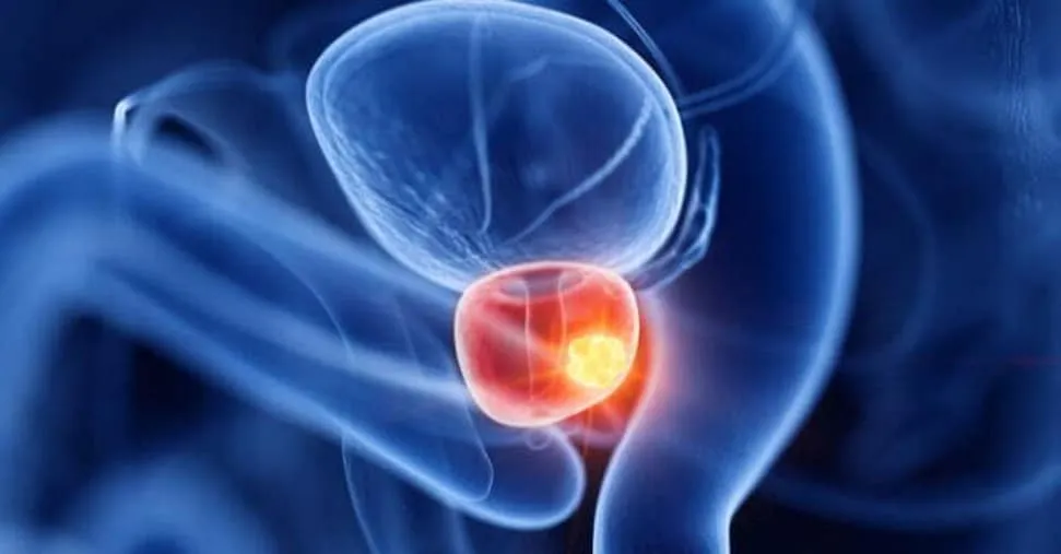Avere rapporti sessuali frequenti previene il cancro alla prostata?