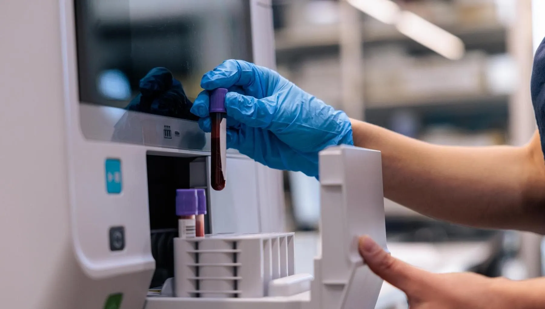 Tumore al pancreas: un nuovo test del sangue aiuterà a trovarlo prima