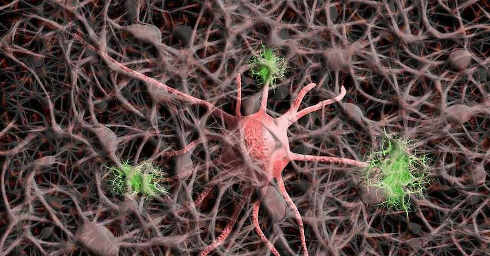 Alzheimer, cure adeguate per 1 paziente su 4. Veneto e Toscana «pronte» per le nuove terapie