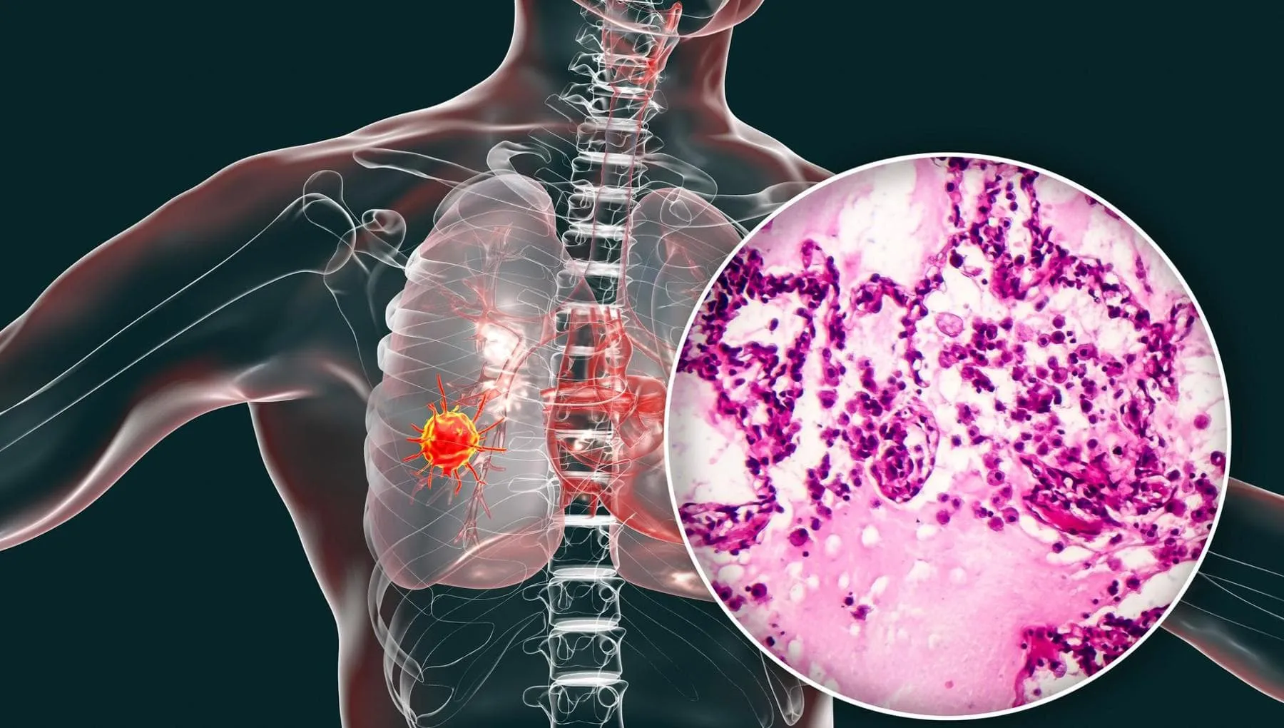 Adenocarcinoma polmonare, cos’è e come si cura il tumore che ha colpito il Papa