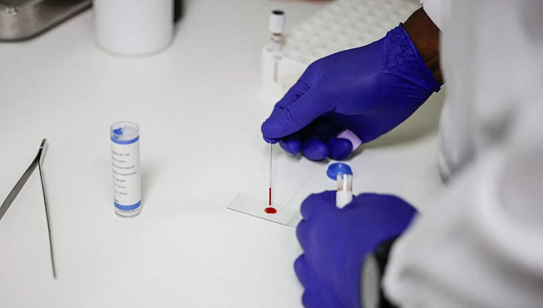 Malaria, cosa la scatena e come riconoscerla