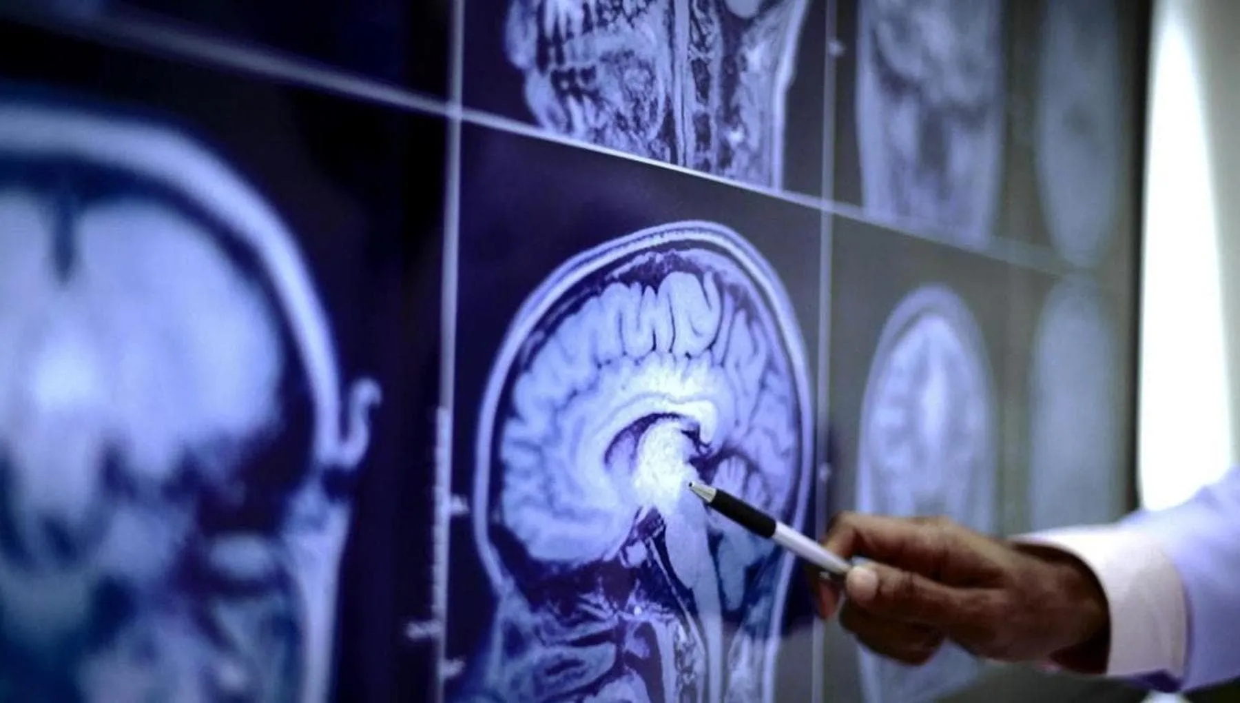 Ictus, ecco il “gemello fisico” dell’arteria: dirà chi è davvero a rischio di ischemia