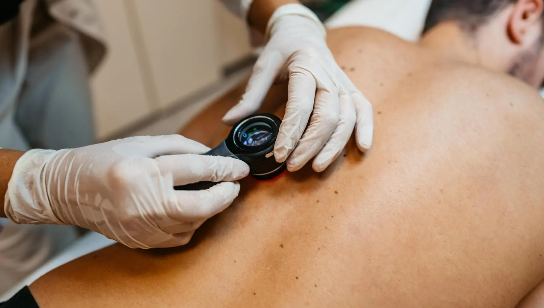 Vaccino per il melanoma a mRNA, positivi i risultati. E Merck e Moderna volano in borsa