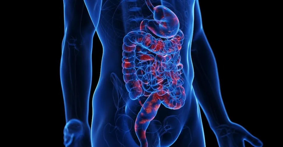 Tumore del colon: ecco le differenze biologiche che lo rendono più aggressivo nei giovani
